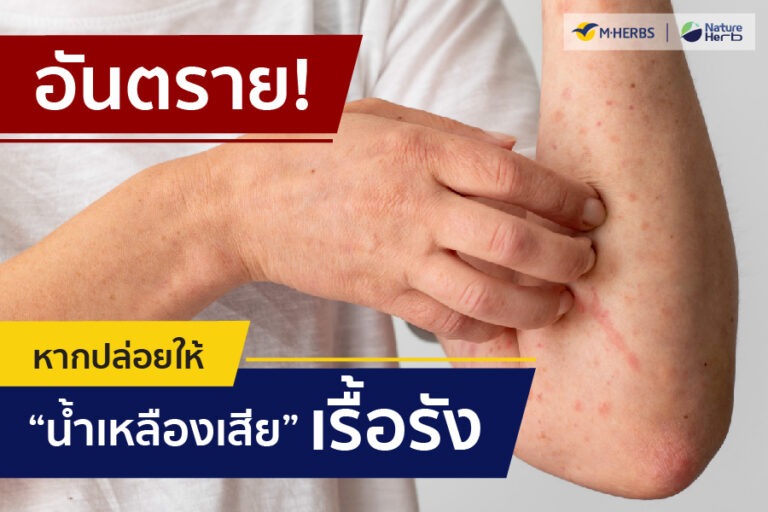 แก้น้ำเหลืองเสียด้วยพลังยาแคปซูลสมุนไพรจาก M•HERBS ที่มีส่วนประกอบของเห็ดกระถินพิมาน ข้าวเย็นเหนือ ข้าวเย็นใต้